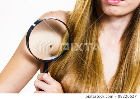 Closeup brown mole on skin. Closeup brown mole on skin. 89226627