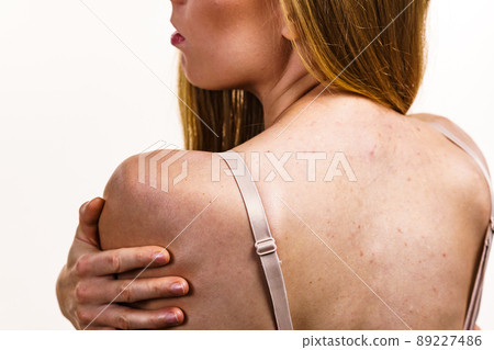 Woman with skin problem acne on back 89227486