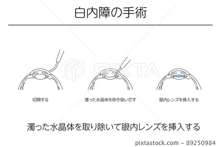 Illustrations, glaucoma surgery, medical illustrations 89250984