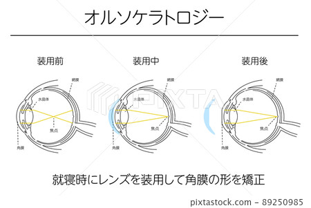 Illustration, vision correction by orthokeratology, medical illustration 89250985