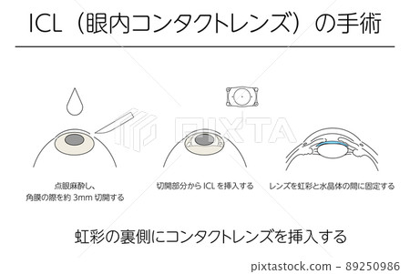 Illustration, vision correction by ICL (intraocular contact lens), medical illustration 89250986