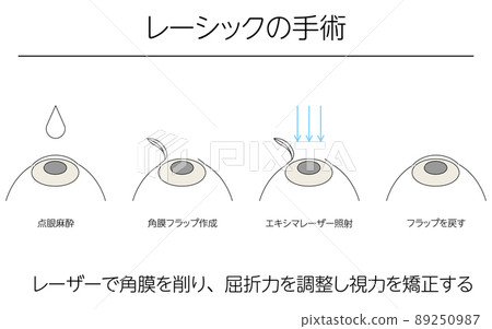 插圖、LASIK 視力矯正、醫學插圖 插圖、LASIK 視力矯正、醫學插圖 89250987