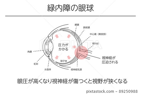 Illustrations, glaucoma eyeballs, medical illustrations Illustrations, glaucoma eyeballs, medical illustrations 89250988