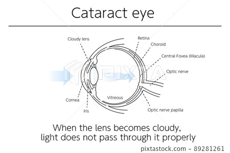 Illustrations, cataract eyeballs, medical illustrations 89281261