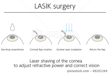 Illustration, LASIK vision correction, medical illustration 89281264