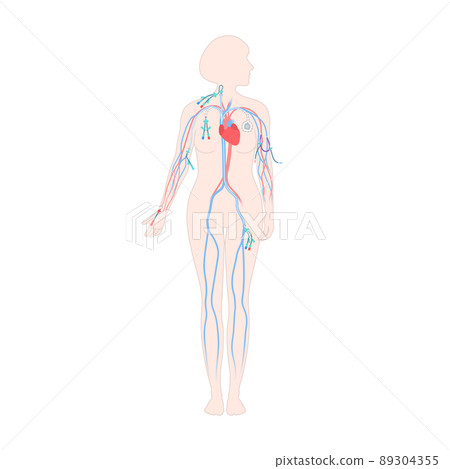 Central line venous catheter types on female body 89304355