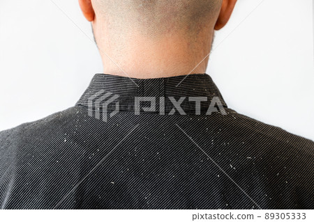 Close up view of man's shoulders in black shirt covered with dandruff. Back view. Copy space. The concept of psoriasis and seborrheic dermatitis 89305333