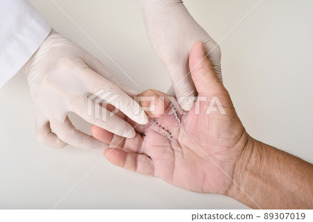 Hand surgery treatment, Trigger finger stiffness painful, Doctor treat patient's injury in hospital 89307019