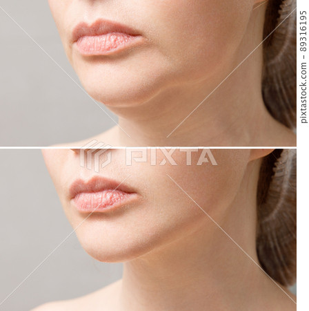 Female double chin before and after correction. Correction of the chin shape liposuction of the neck. The result of the procedure in the clinic of aesthetic medicine. Female double chin before and after correction. Correction of the chin shape liposuction of the neck. The result of the procedure in the clinic of aesthetic medicine. 89316195