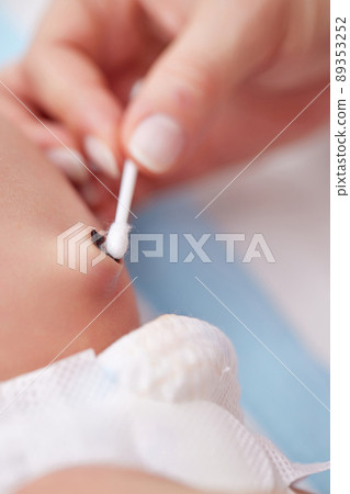 Treatment of newborn baby navel with cotton swab 89353252