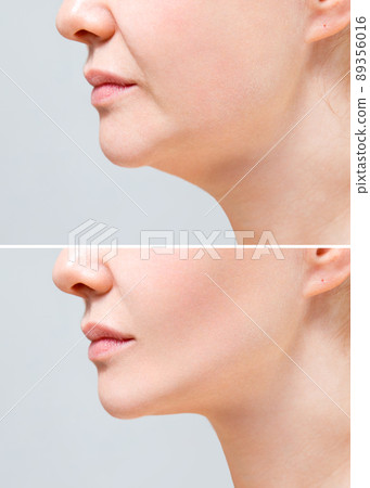 Female nasolabial fold before and after wrinkle smoothing procedures. Correction of the chin shape liposuction of the neck. The result of the procedure in the clinic of aesthetic medicine. 89356016