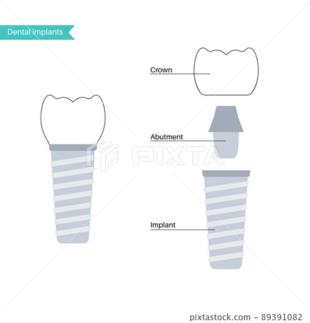 Dental implant procedure Dental implant procedure 89391082