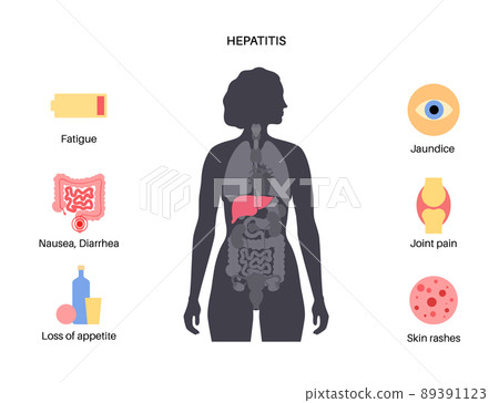 Autoimmune hepatitis disease Autoimmune hepatitis disease 89391123