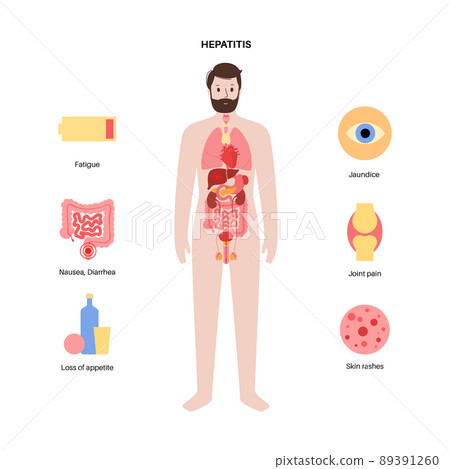 Autoimmune hepatitis disease 89391260