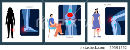 Bursitis inflammation concept 89391362