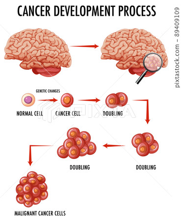 Diagram showing cancer development process Diagram showing cancer development process 89409109