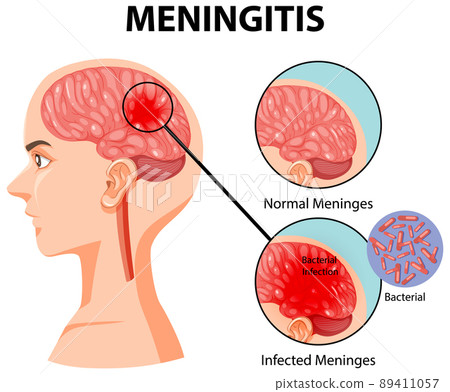 Diagram showing meningitis in human brain Diagram showing meningitis in human brain 89411057