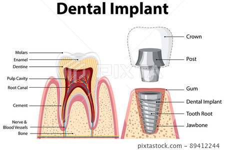 Infographic of human in structure of the dental implant 89412244