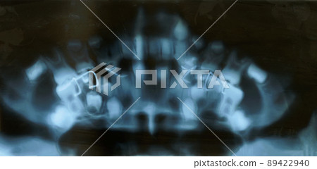 Dental x-ray with metal clips, dental research. Radiography teeth 89422940