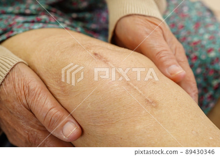 Asian elderly woman patient with scar knee replacement surgery in hospital. Asian elderly woman patient with scar knee replacement surgery in hospital. 89430346