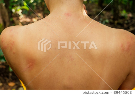 Woman with itching from biting insect in body in tropical jungle forest Woman with itching from biting insect in body in tropical jungle forest 89445808