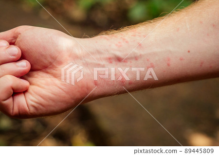 Woman with itching from biting insect in body in tropical jungle forest Woman with itching from biting insect in body in tropical jungle forest 89445809