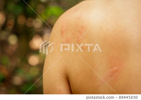 Woman with itching from biting insect in body in tropical jungle forest Woman with itching from biting insect in body in tropical jungle forest 89445830