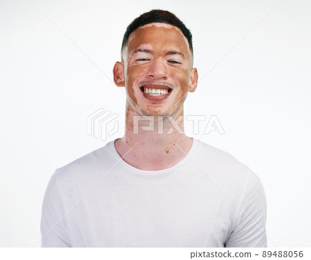 I have my flaws but I embrace them and love them because theyre mine. Portrait shot of a handsome young man with vitiligo posing on a white background. 89488056