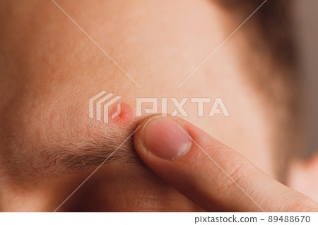 Pimple on the man's forehead above eyebrow. Designated by color close-up Pimple on the man's forehead above eyebrow. Designated by color close-up 89488670