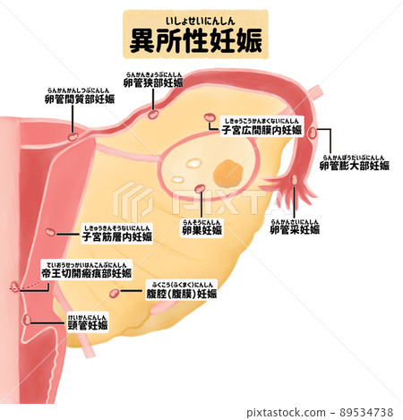 Illustrated illustration of the most common site of ectopic pregnancy (ectopic pregnancy) in Japanese 89534738