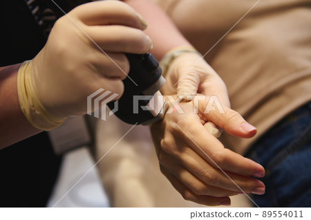 Removal of pigment spots and hair from the hands using a medical laser in a spa clinic Removal of pigment spots and hair from the hands using a medical laser in a spa clinic 89554011