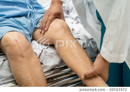 Asian senior or elderly old lady woman patient show her scars surgical total knee joint replacement Suture wound surgery arthroplasty on bed in nursing hospital ward, healthy strong medical concept. Asian senior or elderly old lady woman patient show her scars surgical total knee joint replacement Suture wound surgery arthroplasty on bed in nursing hospital ward, healthy strong medical concept. 89583972