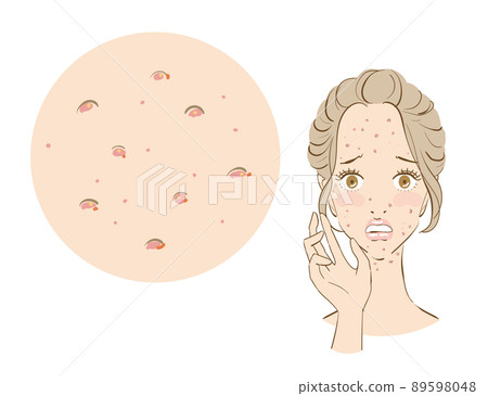 一個患有痤瘡皮膚的可愛女人 89598048