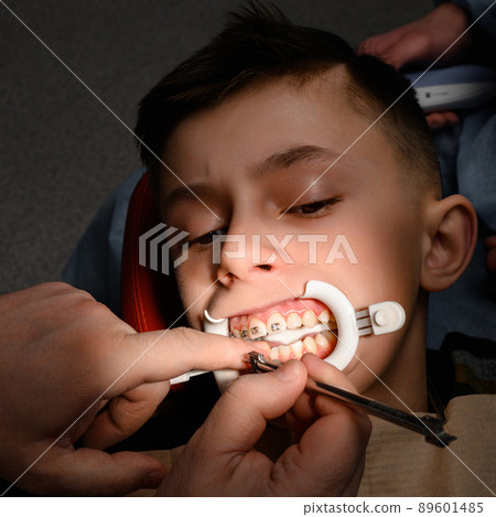 Close up of installing braces on teeth, aligning teeth with braces, retractor on lips. 89601485