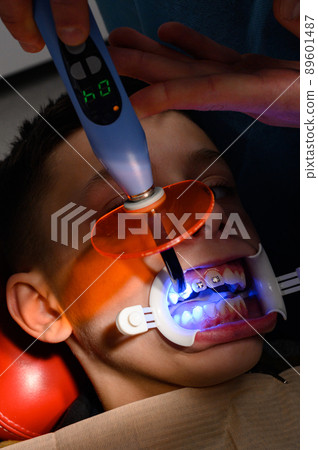 Alignment of crooked teeth with the help of braces, installation of braces for a child, an orthodontist glues metal plates braces for teeth alignment. 89601487