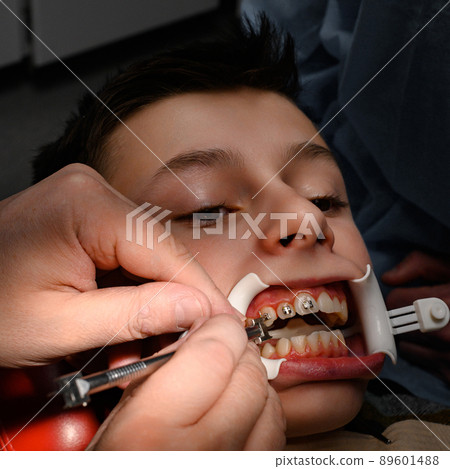 The orthodontist installs braces for the student's boyfriend, visits to the dentist, installation of braces, retractor on the patient's lips. The orthodontist installs braces for the student's boyfriend, visits to the dentist, installation of braces, retractor on the patient's lips. 89601488
