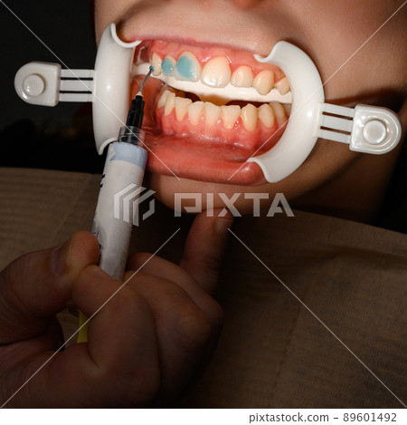 Plastic retractor for lip augmentation in the mouth, dental procedure and retractor as an auxiliary element. 89601492