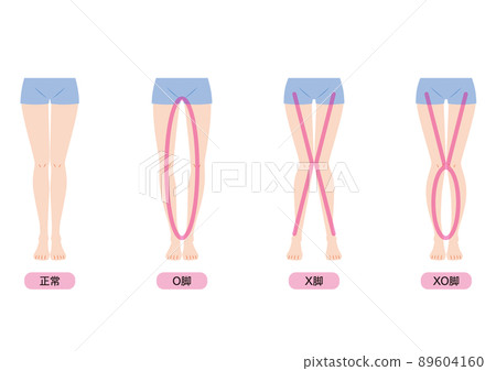 O型腿、X型腿、XO型腿 O型腿、X型腿、XO型腿 89604160