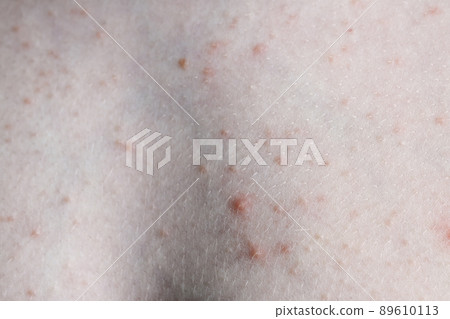 Close up image of a little boy's body suffering severe urticaria, nettle rash also called hives 89610113