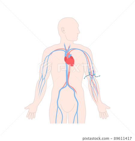 Arteriovenous dialysis shunt graft catheter in male arm 89611417