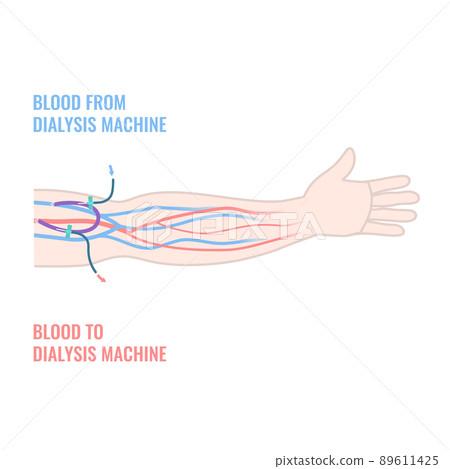 Arteriovenous dialysis shunt graft catheter in arm 89611425
