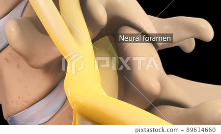Anatomical view of the cervical spine with intervertebral disc-compressive nerve root prolapse Anatomical view of the cervical spine with intervertebral disc-compressive nerve root prolapse 89614660