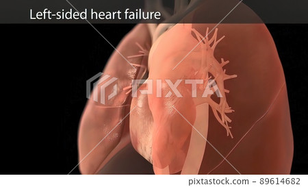 illustration Congestive Heart Failure illustration Congestive Heart Failure 89614682