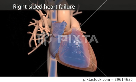 illustration Congestive Heart Failure illustration Congestive Heart Failure 89614683