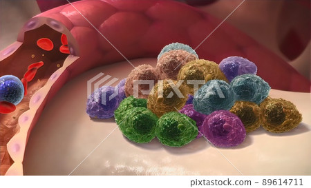 Multiple Myeloma, a type of cancer that consists of white blood cells and its spread Multiple Myeloma, a type of cancer that consists of white blood cells and its spread 89614711