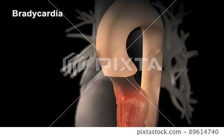 Bradycardia: This means a slow heartbeat - resting heart rate of less than 60 beats per minute Bradycardia: This means a slow heartbeat - resting heart rate of less than 60 beats per minute 89614740