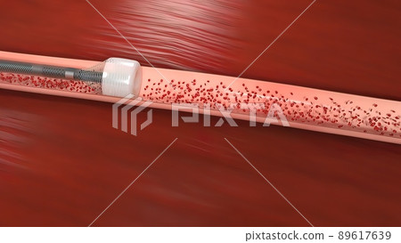 Vascular occlusion is a blockage of a blood vessel, usually with a clot. Vascular occlusion is a blockage of a blood vessel, usually with a clot. 89617639
