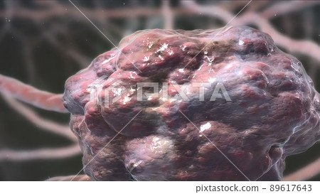 Cancer cell in the vascular system 89617643