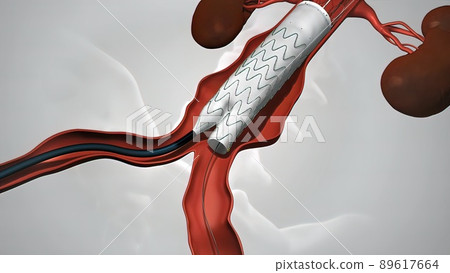 balloon angioplasty procedure with stent in vein 89617664