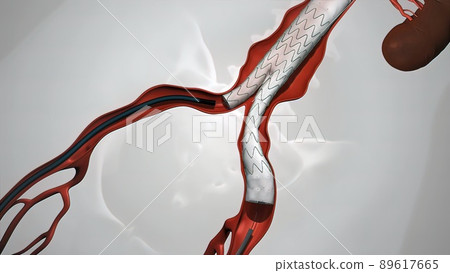 balloon angioplasty procedure with stent in vein 89617665